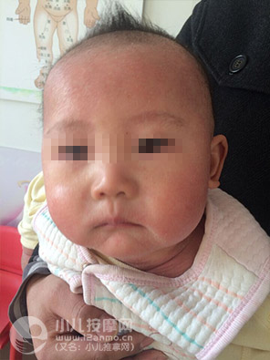 小兒推拿調理幼兒濕疹案例圖片9
