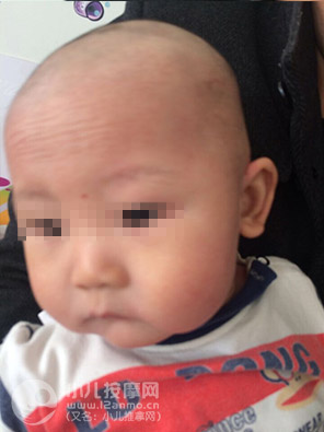 小兒推拿調理幼兒濕疹案例圖片11
