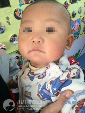 小兒推拿調理幼兒濕疹案例圖片13